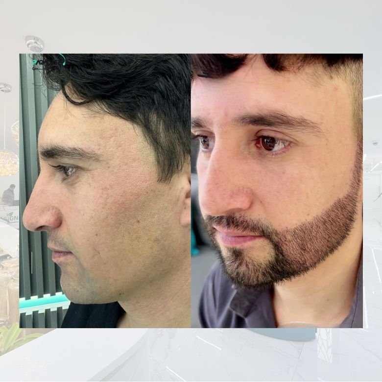 Beard Transplant