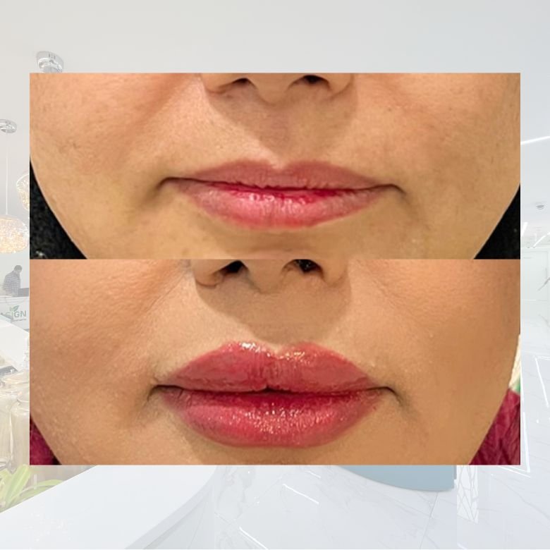 Lip Filler