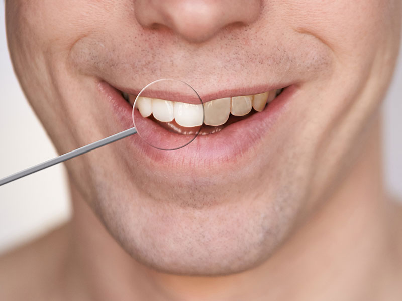teeth whitening - Teeth Whitening