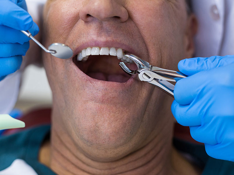 tooth extraction - Tooth Extraction